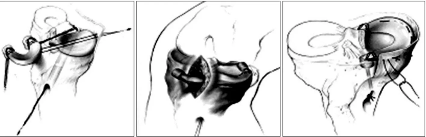 Fig. 1. The figure shows fixation methods of meniscal transplantation: Bone-plug method.