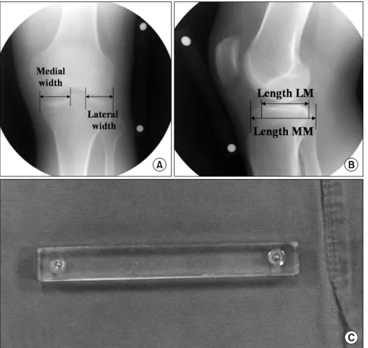 Fig. 3. Preoperative sizing of  meniscal  allografts.  (A)  The  true AP radiograph was used  to  measure  meniscus  width