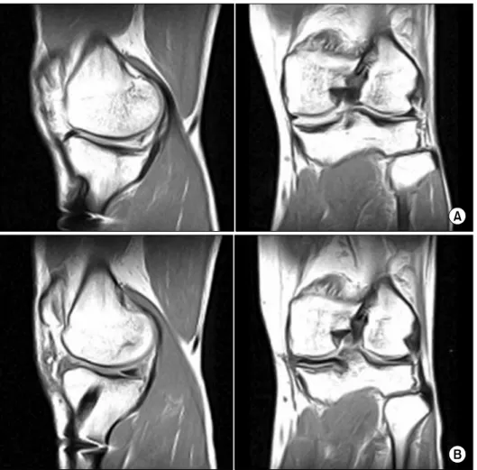 Fig. 6. Preoperative and Pos- Pos-toperative MRI: coronal MRI  image shows normal meniscal  position