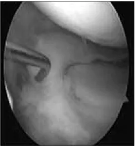 Fig. 7. Second look arthroscopic finding at 7 months after  meniscal transplantation: it shows complete healing with firm  attachment around the entire circumference of the meniscal  rim and no shirinking meniscal size