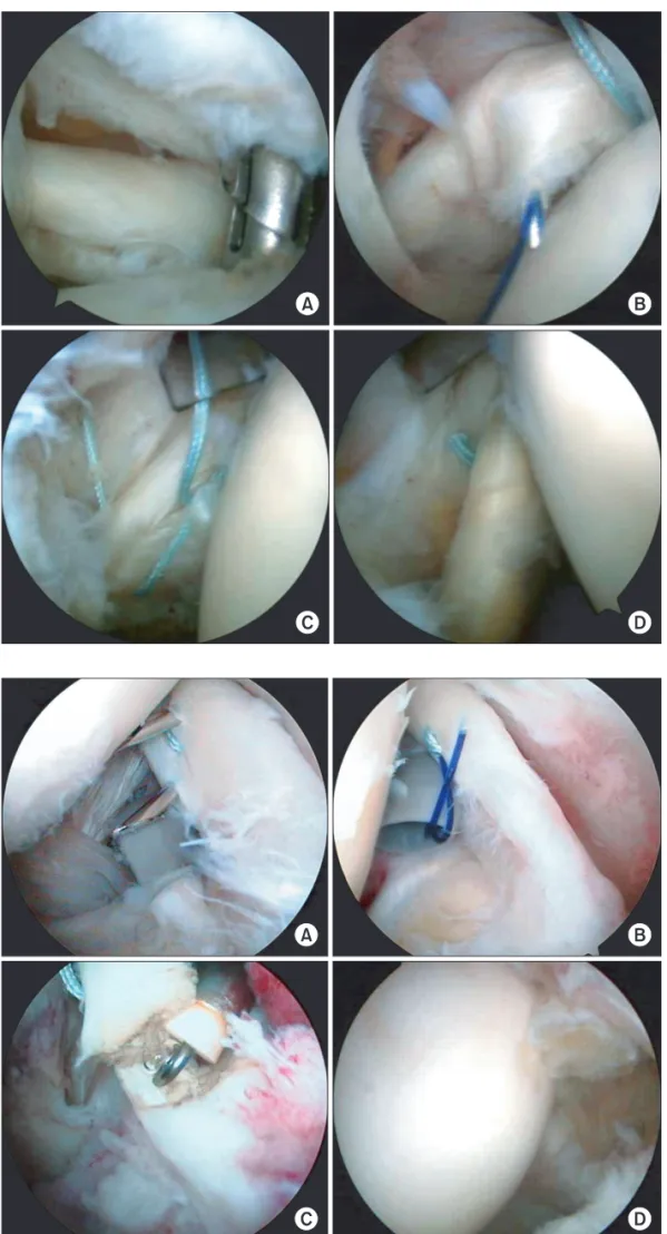 Fig. 3. (A, B) Introduction of 18-G spinal  needles  through  the  biceps  tendon  through most of the superolateral rotator  interval tissue followed by passing the  polydioxanone suture through the 18-G  needles to switch to FiberWire suture
