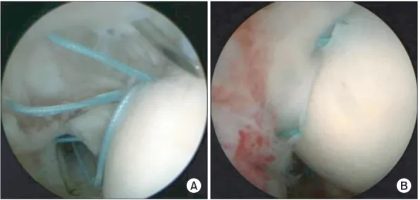 Fig. 4. (A) The polydioxanone suture  passing through each of the 18-G spinal  needles to exchange it into a loaded  suture  on  the  anchor  following  the  insertion of 3.7 mm suture tak anchor  at the far medial edge of the footprint  at a dead man’s an