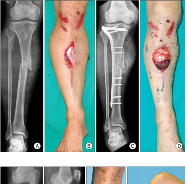 Fig. 2. Follow-up radiograph after 1 year  shows solid union of fracture (A, B) with  an excellent function (C, D).