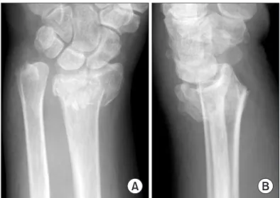 Fig. 1. Initial anteroposterior (A) and lateral (B) plain radiographs  show the intra-articular comminuted distal radius fracture with dorsal  displacement.