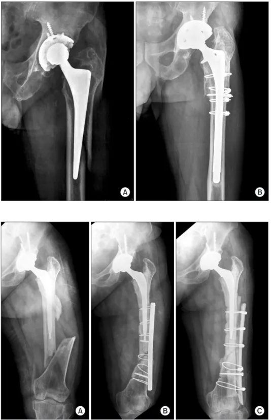 Fig.  2.  (A)  A  Vancouver  type  C  periprosthetic femoral fracture. (B) A  radiograph  showing  nonunion  with  varus deformity at 10 months  follow-up after open reduction and internal  fixation  with  a  plate