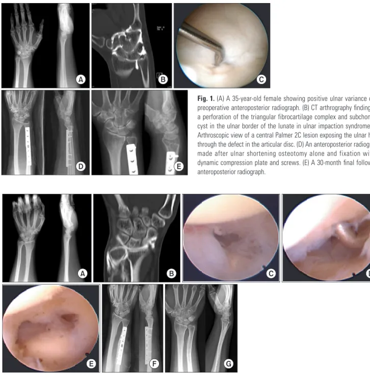 Fig. 2. (A) A 45-year-old female showing positive ulnar variance on a preoperative anteroposterior radiograph
