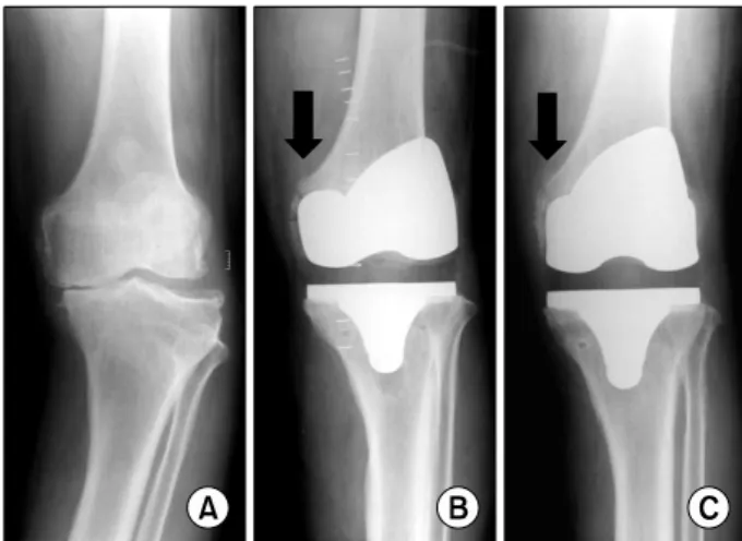 Table  2. The Angle of the Implant Position