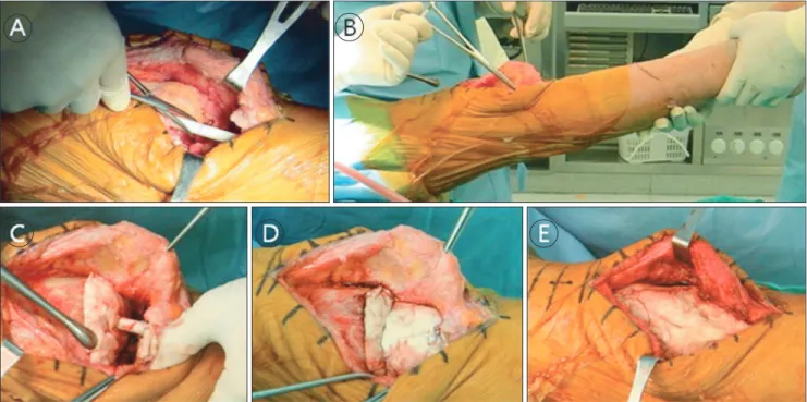 Fig. 2. Intramedullary nailing technique with the cement-impregnated rod. (A) Insertion of the cement-impregnated nail into the medullary canals of  the femur and tibia, and approximation of the joint line and space with a previously marked line on the nai