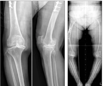 Fig. 2. Soft tissue balancing under navigation guide in total knee arthroplasty. Navigation helps to check the balance of extension gap (A) and fl exion  gap (B).