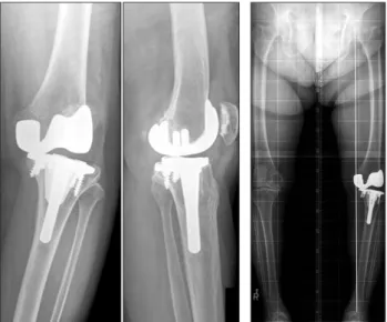 Fig. 4. Application of computer assisted surgery technique in revision  total knee arthroplasty