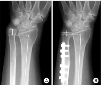 Fig. 2. (A) The preoperative lateral radiograph showed the measurement  of the radioulnar distance (RU)