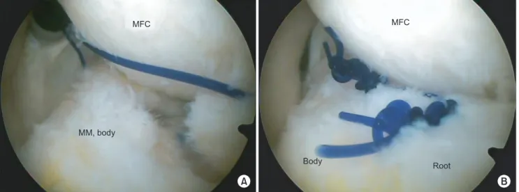 Fig. 3. (A) Arthroscopic view of the suture connecting the root and body portion of the torn meniscus