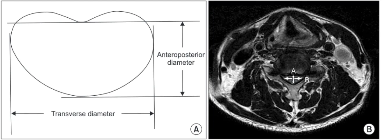 Fig. 1. (A) Compression ratio of the spinal cord = anteroposterior diameter / transverse diameter × 100