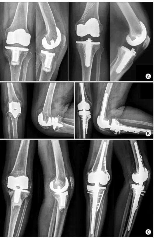 Fig. 2. A cemented posterior stabilized  prosthesis was used if both collateral  ligaments were felt to be competent and  a condylar constrained knee or  rotat-ing hrotat-inge knee prosthesis was used if  more than one of collateral ligaments  were incompe