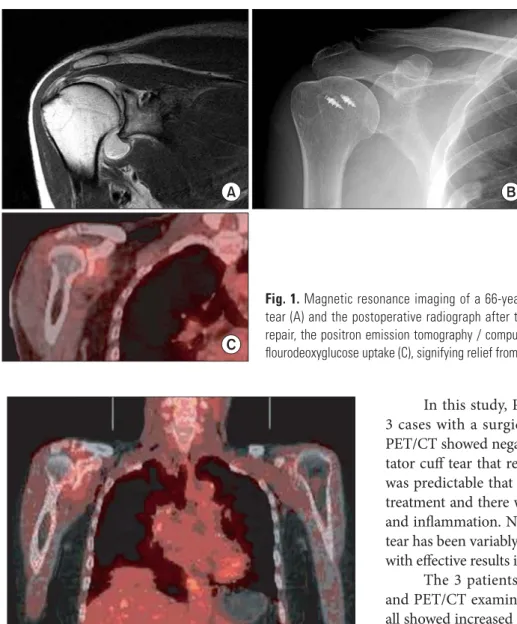 Fig. 2. A 69-year-old female patient with rheumatoid arthritis in the  shoulder shows generalized increased uptake on the left side.