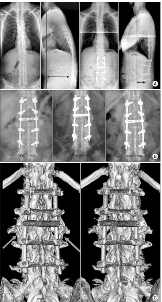 Fig. 2. (A) Kyphotic deformity due to  ankylosing spondylitis in a 31-year-old  man. Correction was achieved after  pedicle subtraction osteotomy at L3