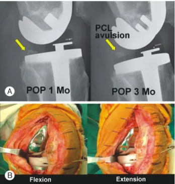 Fig. 3.  A; PCL avulsion was noted 3 months after TKA (CR  type),  B; Instability was noted in flexion.