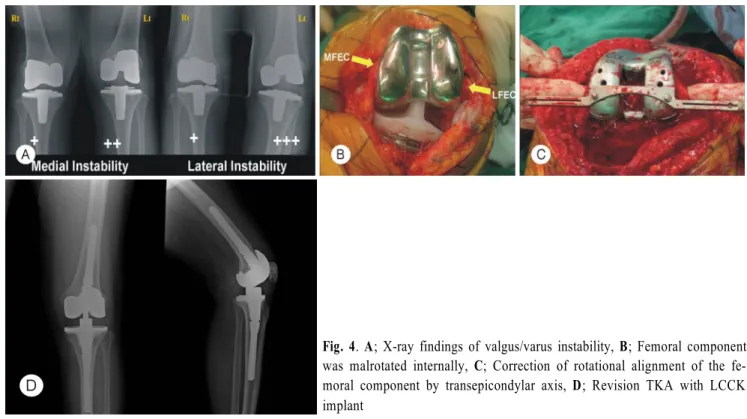 Fig. 4.  A; X-ray findings of valgus/varus instability, B; Femoral component  was malrotated internally, C; Correction of rotational alignment of the fe-  moral component by transepicondylar axis, D; Revision TKA with LCCK  implant 였다