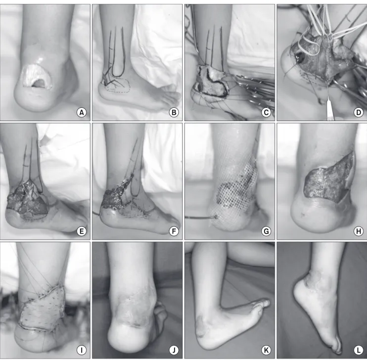 Fig. 1.  (A) Post-traumatic soft tissue defect with exposure of the calcaneus and Achilles tendon in a 4-year-old female