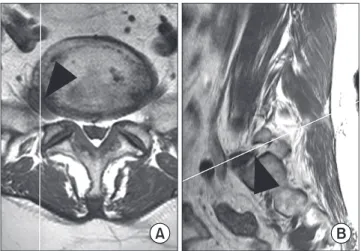 Fig. 2. The axial (A) and sagittal (B) MR images of a 58 year-old woman  are shown. The white line in each figure indicates the sectioning plane  for the other figure