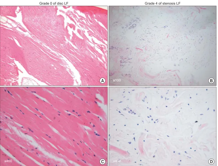 Fig. 2. Grading of the ligamentum fl avum elastin degradation by hematoxylin-eosin staining