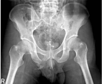 Fig. 1. Radiograph showed bilateral anterior dislocation of both hip joints  and disruption of the axial alignment at L4/5.