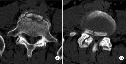 Fig. 6. Postoperative radiographs showed posterior segmental fixation  from L3 to S1.