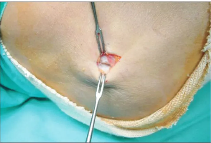 Fig. 1. Via minimal skin incision, origin of extensor carpi radialis  brevis (ECRB) muscle was approached