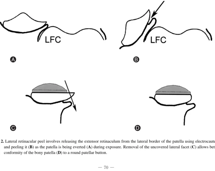 Fig. 2. Lateral retinacular peel involves releasing the extensor retinaculum from the lateral border of the patella using electrocautery and peeling it (B) as the patella is being everted (A) during exposure