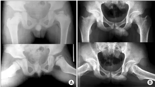 Fig. 4. (A) An example of a right hip in group C1 of the modifi ed lateral pillar classifi cation in a patient who was 4.3 years old at presentation