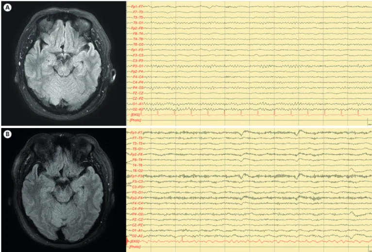 Fig. 1. Brain MRI analysis. (A) Initial FLAIR enhanced image showed no abnormal lesion