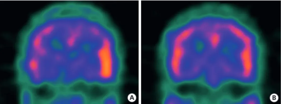 Fig. 2. Brain perfusion single photon emission computed tomography. (A) Increased perfusion in the left lateral  temporal cortex
