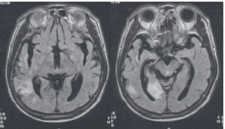 Fig. 1. Brain magnetic resonance imaging. Fluid attenuated inversion recovery images show an infarction in the  territory of the right posterior cerebral artery.