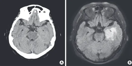 Fig. 1. Brain images. Brain CT (A) shows only a mild atrophy and several small vessel lesions, but Brain MRI (B),  T2-weighted fluid-attenuated inversion recovery images shows multiple infiltrative lesions