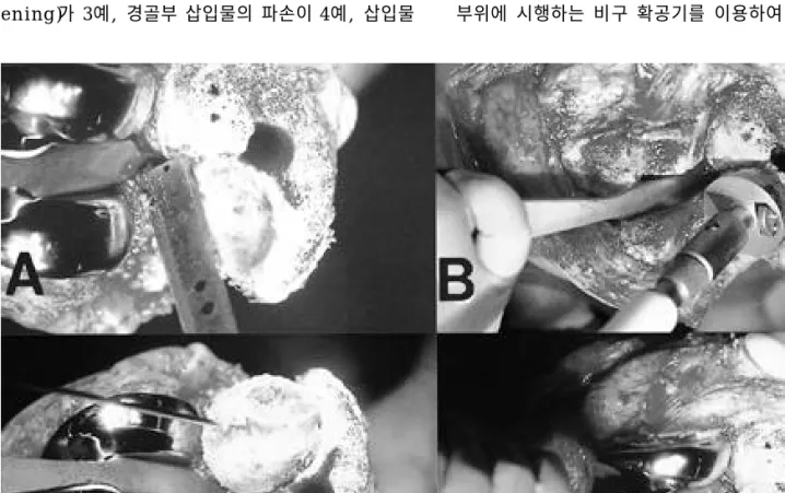 FIGURE 2. (A) Large bone defect of uncontained type on medial tibial condyle. (B) Preparation of bone defect using acetabular reamer