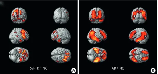 Fig. 2. Group comparison of  18 F-THK5351 positron emission tomography. Colored areas represent brain regions  corresponding to increased THK retention from voxel-wise statistical analyses in (A) the bvFTD group compared  to the NC group (bvFTD > NC) an