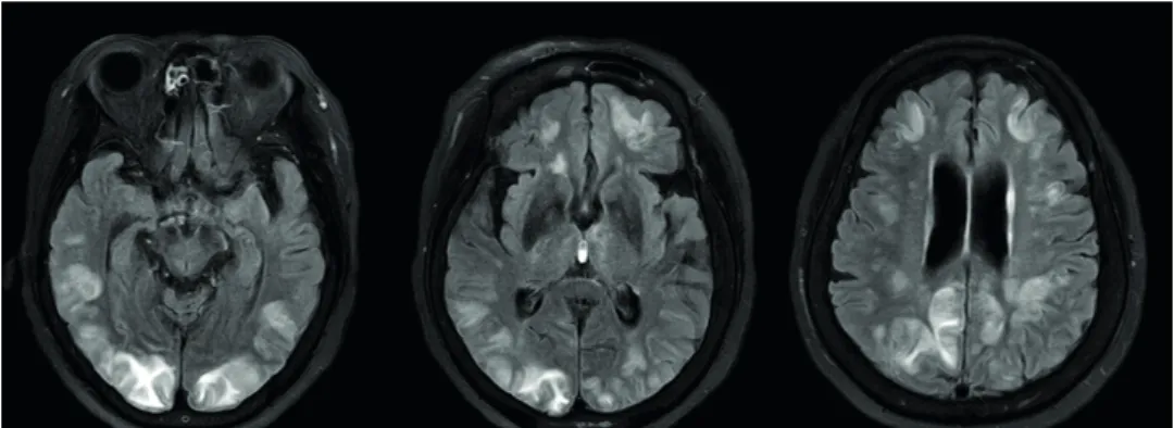 Fig. 1. Initial fluid-attenuated inversion recovery scan showed symmetric high signal intensities in both cerebral  hemisphere, especially in parieto-occipital subcortical areas.