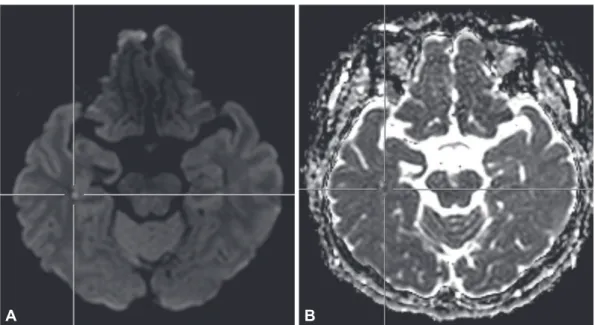 Fig. 1. Hippocampal hyperintensity in diffusion-weighted imaging in case 1. A: Diffusion-weighted images
