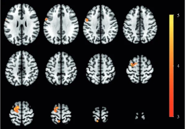 Table 2. Changes in regional cerebral blood flow after nicergoline  treatment