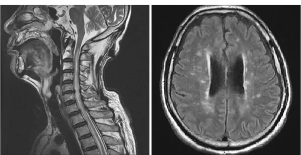 Fig. 1. Sagittal T2-weighted image of spine shows diffuse enlargement of cervical and thoracic spinal cord and continuous high signal in- in-tensity in the central gray matter from C1 level