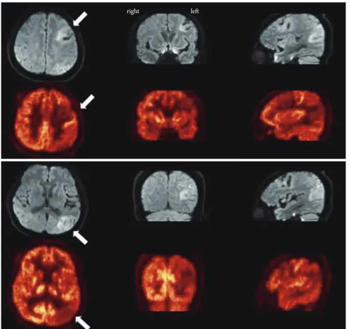 Fig. 1. Diffusion weighted images (upper row) and corresponding FDG-PET CT images (lower row) revealed destructive lesions (white ar- ar-row) in the area of left frontal and left parietal lobe
