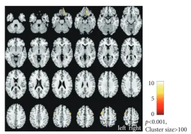 Fig. 4. The middle frontal gyrus bilaterally showed greater activa- activa-tion after six months in parallel with Hanja reading improvement  (Threshold at p<0.001, uncorrected, cluster size >100)