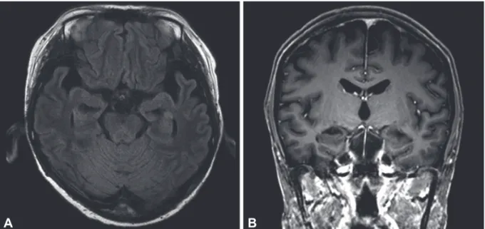Fig. 1. Brain MR images in the patient. A: An axial fluid-attenuated inversion recovery image demonstrates an atrophic change in the bilat- bilat-eral medial temporal lobes without abnormal high signal intensity