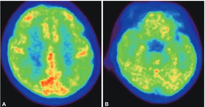 Fig. 2. 18F-Fludeoxyglucose-PET performed 8 weeks after transplantation shows global hypometabolism in the bilateral medial temporal  lobes and the fronto-parietal cortices