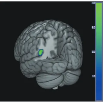 Fig. 2. Decreases in brain perfusion at follow-up in the PD with  SCI group compared with baseline