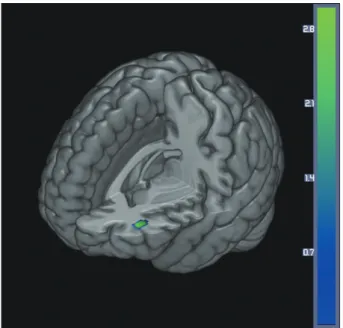 Fig. 3. Excessive decrease in cerebral perfusion specific to the  PD with SCI group compared with the PD without SCI group