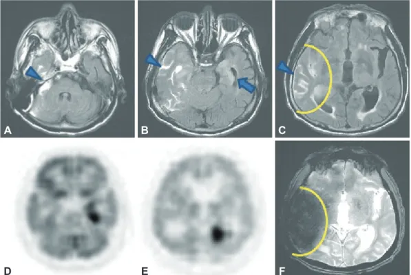 Fig. 1. Fluid-attenuated inversion recovery images (A), (B), and (C) show hyperintense cerebrospinal fluid (CSF) on right temporal area (ar- (ar-rowhead) and a high signal intensity lesion on left medial temporal area suspicious of limbic encephalitis (B) 