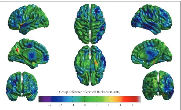 Fig. 1. Decreased cortical thickness (cold scale: blue-green) and increased cortical thickness (hot scale: red-yellow) across brain regions in  illiterate vs