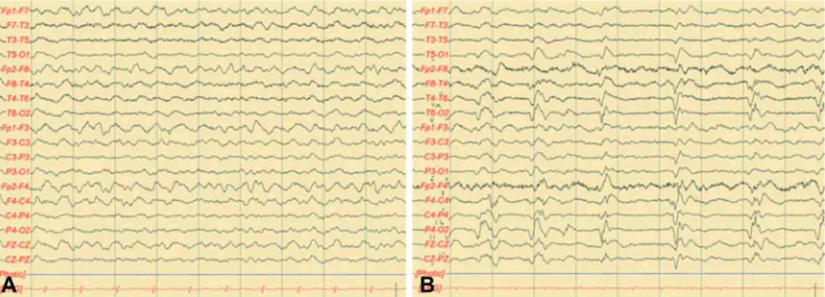 Fig. 2. Initial EEG showed generalized continuous slow activity (A). Follow-up EEG recorded 8 months later shows periodic lateralized epi- epi-leptiform discharges over the right hemisphere (B)