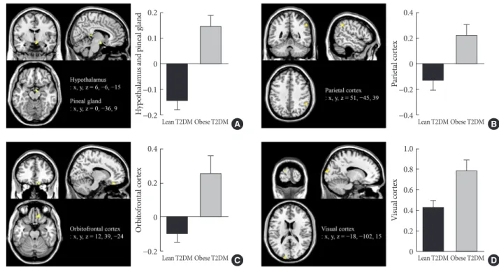 Fig. 2. Differences in brain responses to visual food cues in lean and obese individuals with type 2 diabetes mellitus (T2DM)